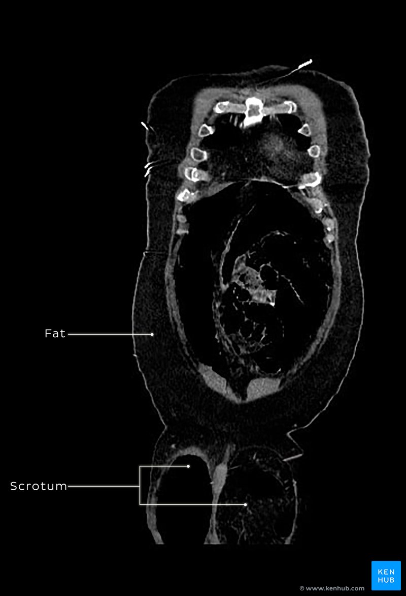 Giant inguinal hernias - Coronal CT at sternum level