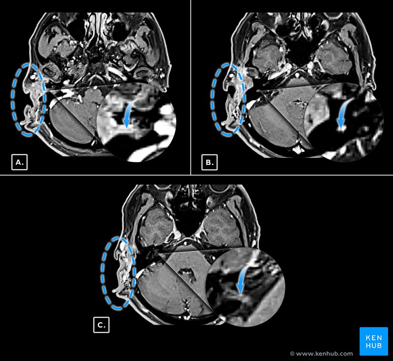 Malignant Peripheral Nerve Sheath Tumor Extension and Invasion of the Facial Nerve