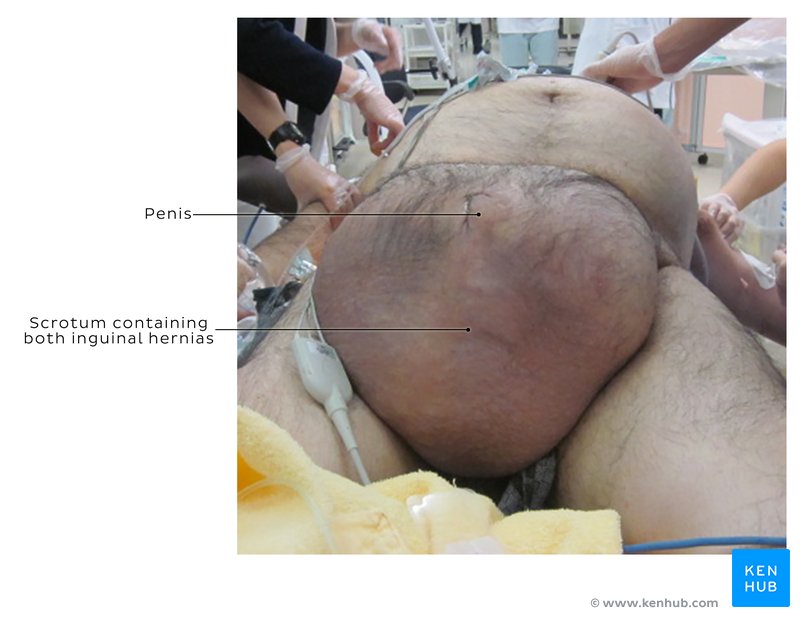 Giant inguinal hernia - Clinical presentation