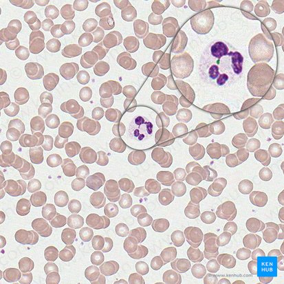 Chromatinum sexuale neutrophili (Geschlechtschromatin des neutrophilen Granulozyten); Bild: 