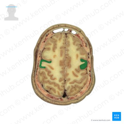 Gyrus precentralis (Vordere Zentralwindung); Bild: National Library of Medicine
