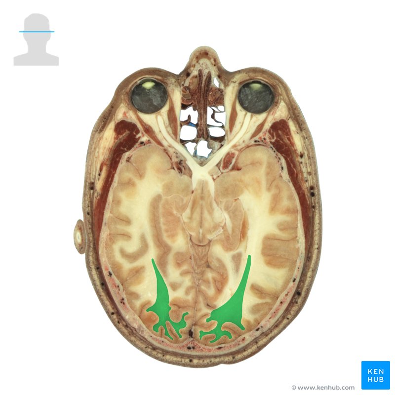 Optic radiation - axial view