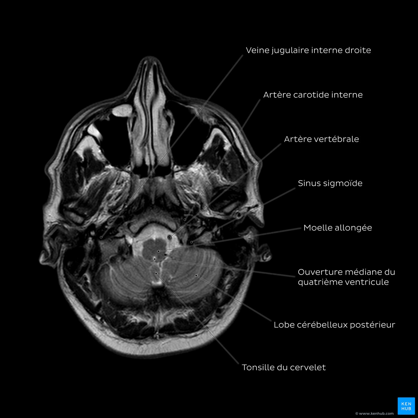 Brain MRI (cerebellum level)