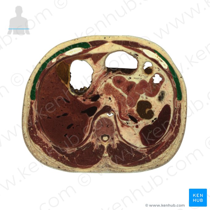 External abdominal oblique muscle (Musculus obliquus externus abdominis); Image: National Library of Medicine