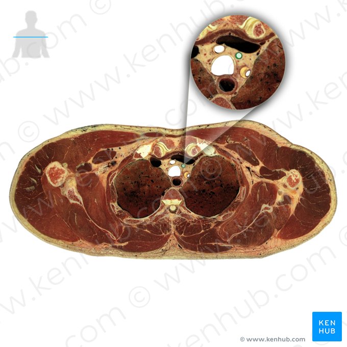 Arteria carotis communis sinistra (Linke gemeinsame Halsschlagader); Bild: National Library of Medicine
