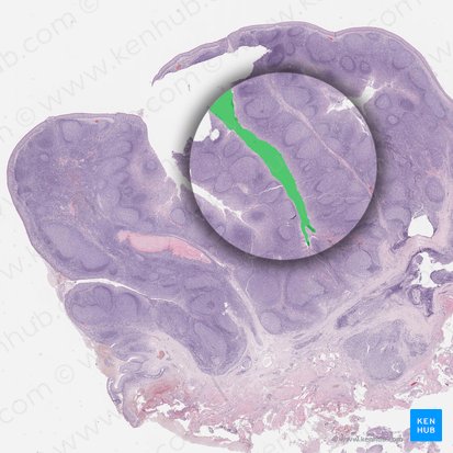 Crypta tonsillae (Mandelkrypte); Bild: 