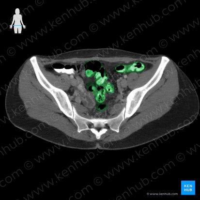 Sigmoid colon (Colon sigmoideum); Image: 