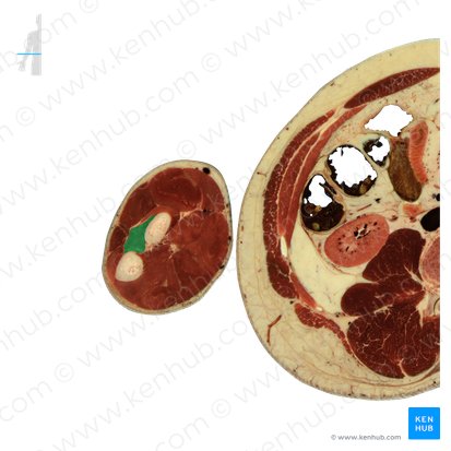 Abductor pollicis longus muscle (Musculus abductor pollicis longus); Image: National Library of Medicine