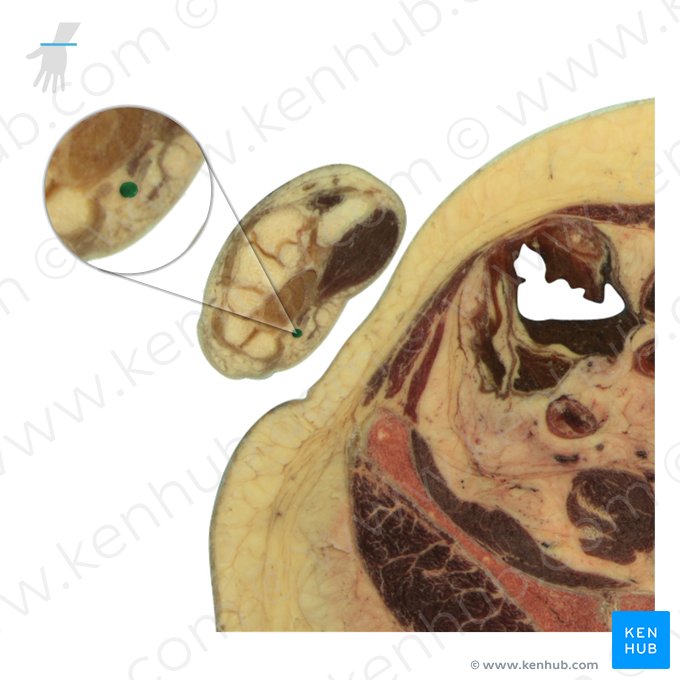 Ulnar artery (Arteria ulnaris); Image: National Library of Medicine