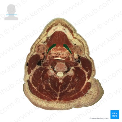 Hyoglossus muscle (Musculus hyoglossus); Image: National Library of Medicine
