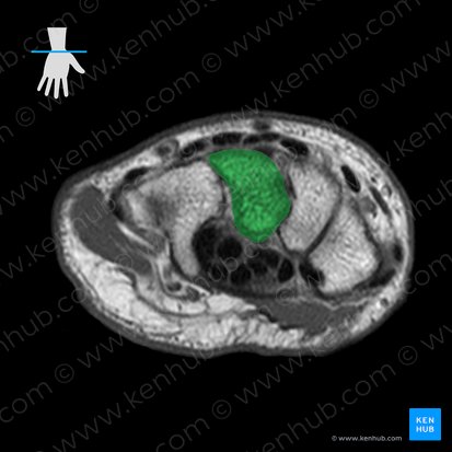 Capitate bone (Os capitatum); Image: 