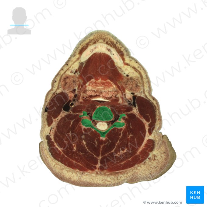Vertebra C4; Image: National Library of Medicine