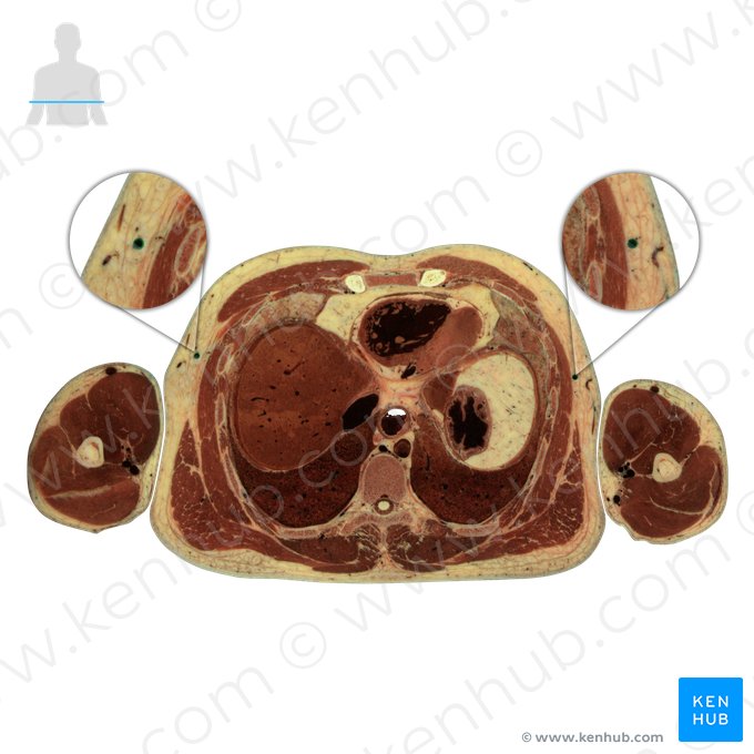 Thoracoepigastric vein (Vena thoracoepigastrica); Image: National Library of Medicine