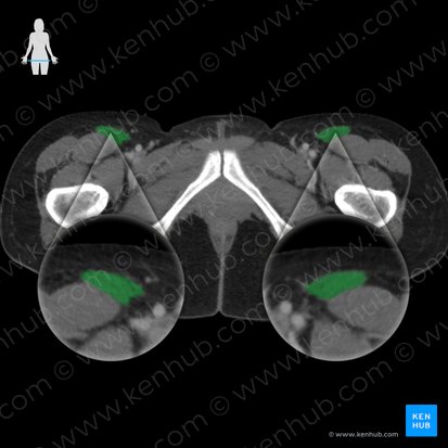 Musculus sartorius (Schneidermuskel); Bild: 