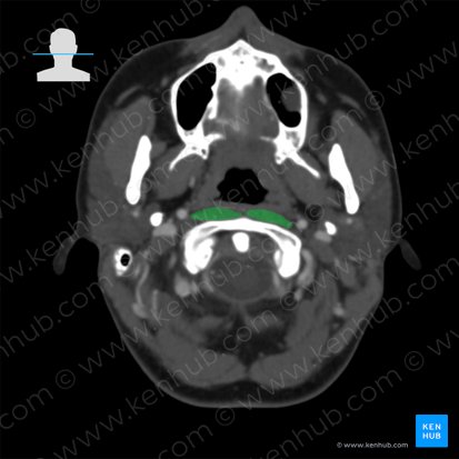 Longus capitis muscle (Musculus longus capitis); Image: 