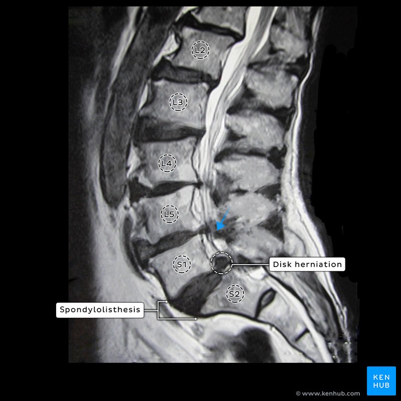 Disk herniation, spondylolisthesis, ligamentum flavum hypertrophy - sagittal view