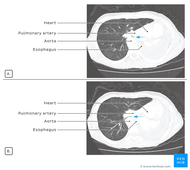Postpneumonectomy syndrome - axial CT