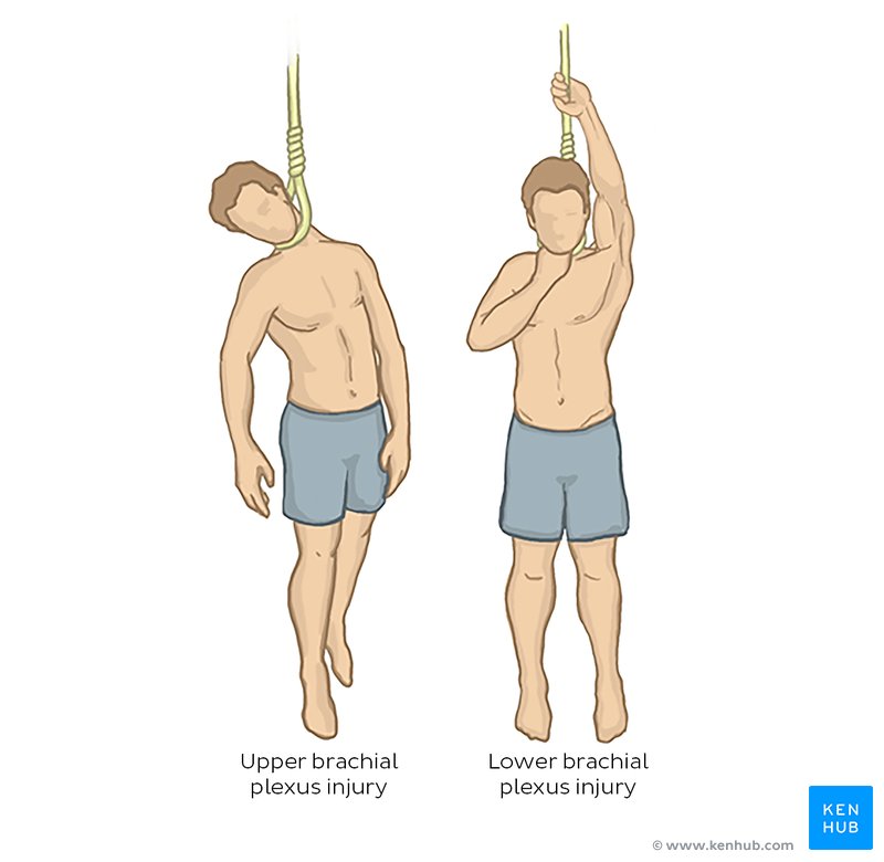 Brachial plexus injury mechanism