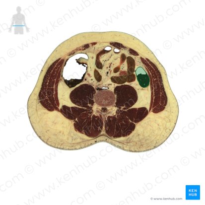 Colon descendens (Absteigender Dickdarm); Bild: National Library of Medicine