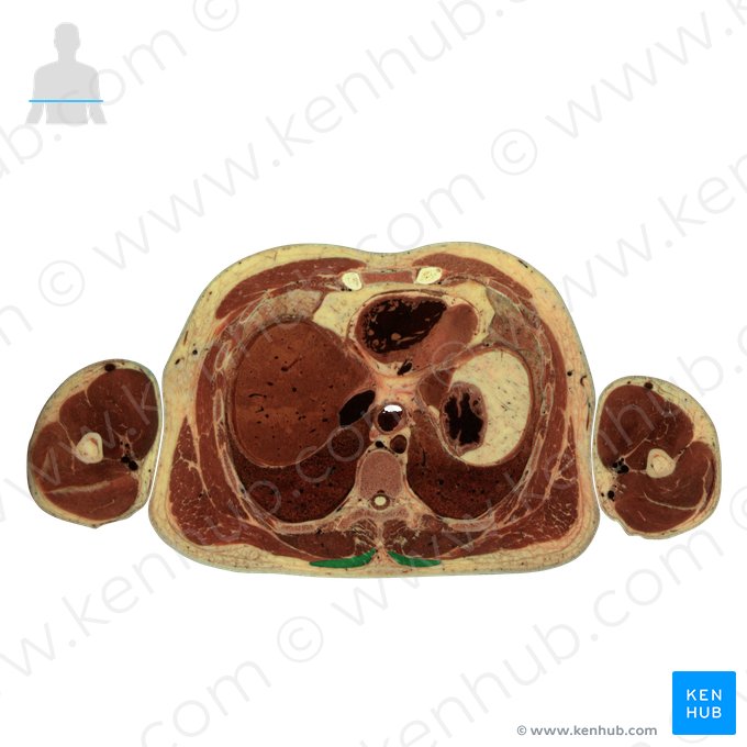 Trapezius muscle (Musculus trapezius); Image: National Library of Medicine