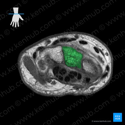 Capitate bone (Os capitatum); Image: 