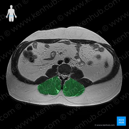 Musculus erector spinae (Rückenstrecker); Bild: 