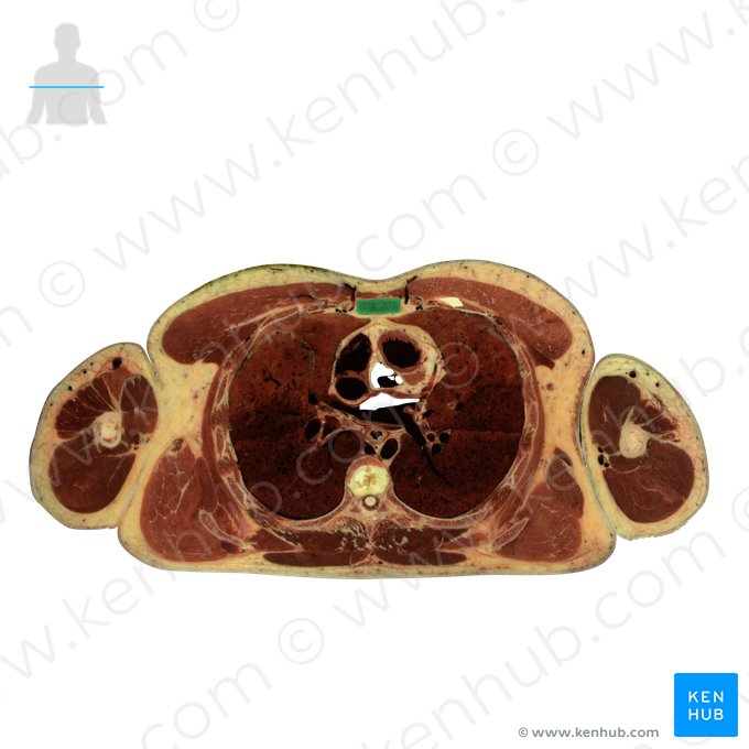 Body of sternum (Corpus sterni); Image: National Library of Medicine