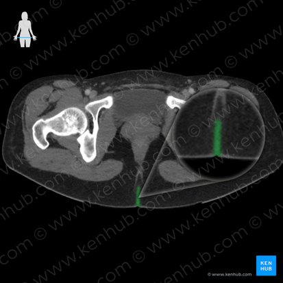 Hendidura interglútea (Crena interglutealis); Imagen: 