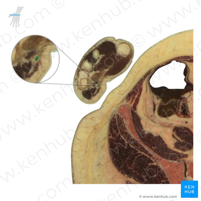 Arteria ulnaris (Ellenarterie); Bild: National Library of Medicine
