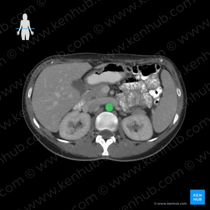 Aorta abdominalis (Bauchaorta); Bild: 