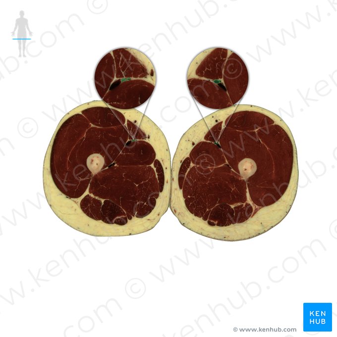 Artéria femoral (Arteria femoralis); Imagem: National Library of Medicine