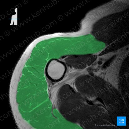 Deltoid muscle (Musculus deltoideus); Image: 