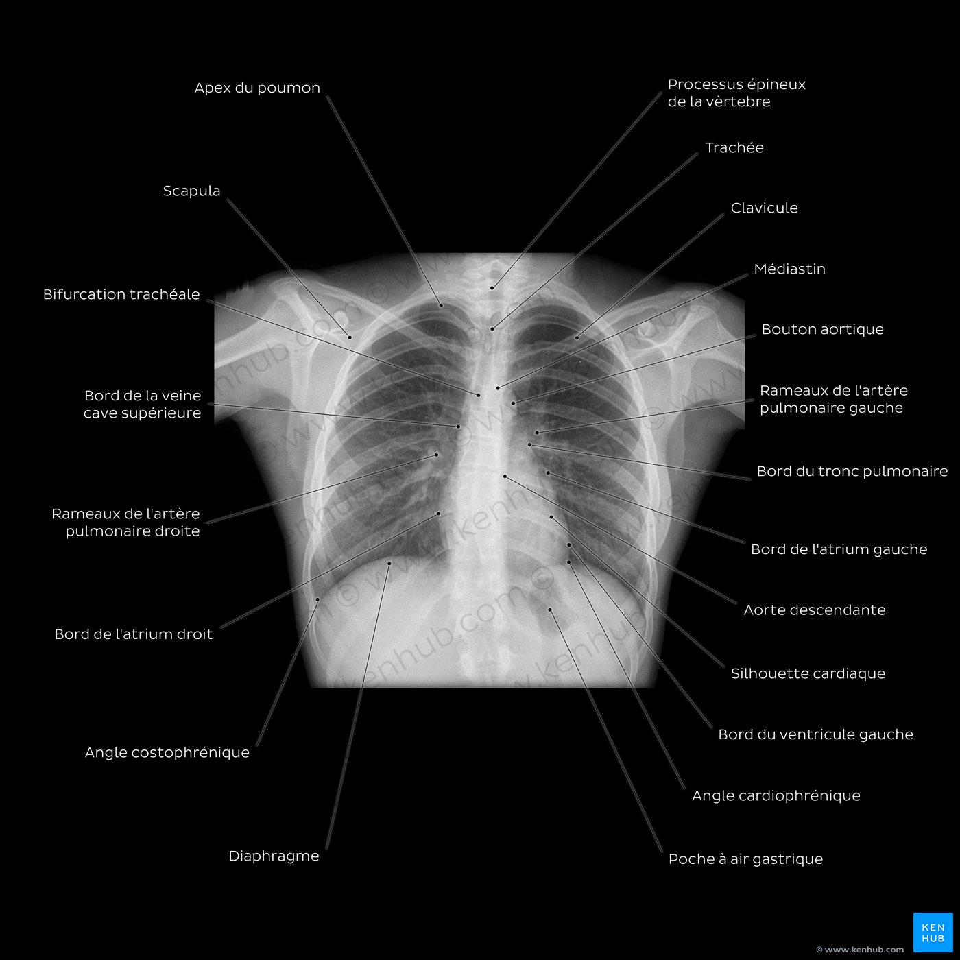 Radiographie thoracique (PA)