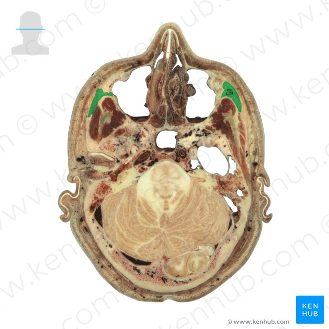 Zygomatic bone (Os zygomaticum); Image: National Library of Medicine