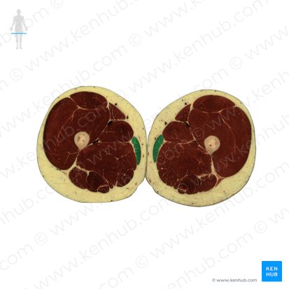 Musculus gracilis (Schlankmuskel); Bild: National Library of Medicine