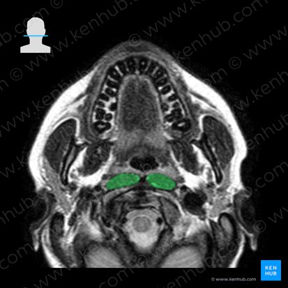 Longus capitis muscle (Musculus longus capitis); Image: 