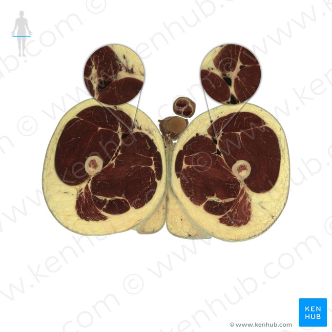 Nervo femoral (Nervus femoralis); Imagem: National Library of Medicine